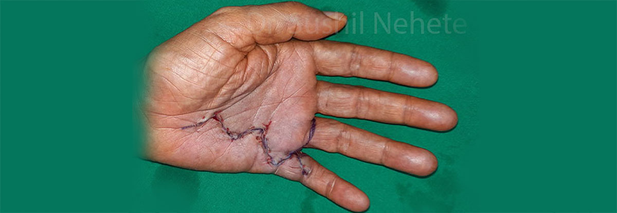Hand Surgery