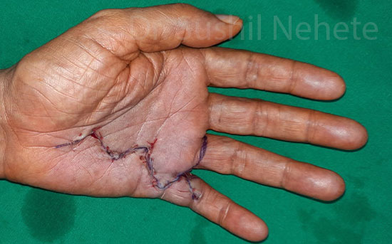 Hand Surgery