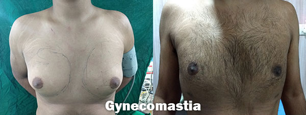 Breast Surgery