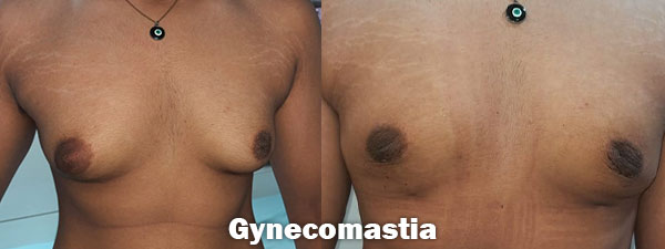 Breast Surgery