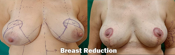 Breast Surgery