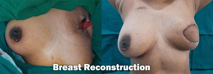 Breast Surgery