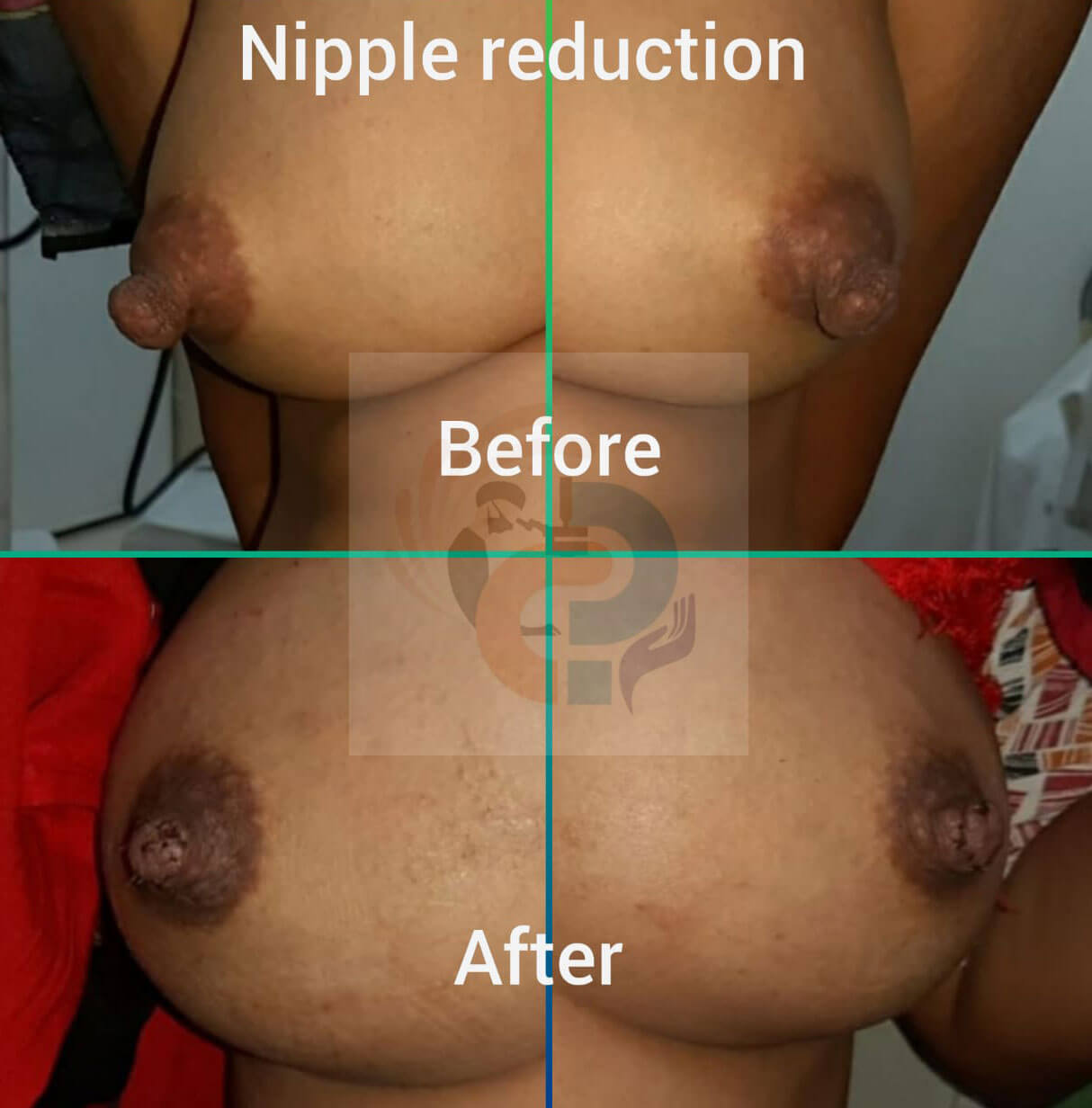 Breast Surgery