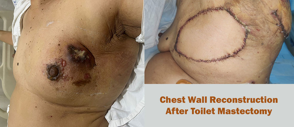 Breast Surgery