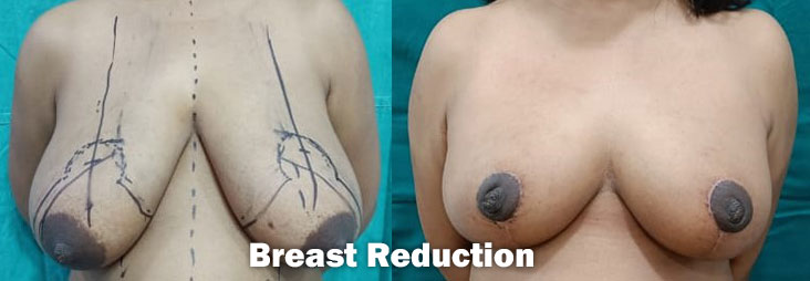 Breast Surgery