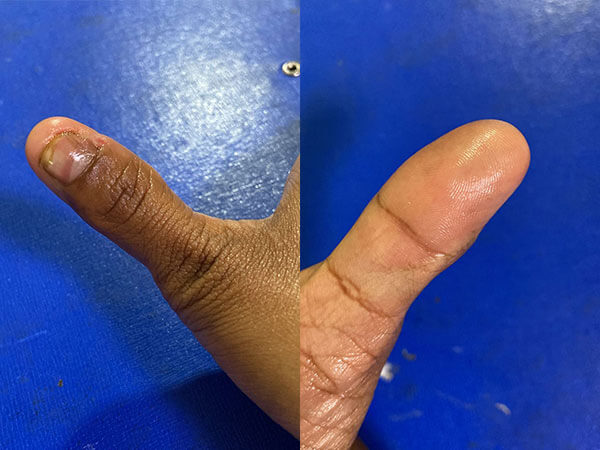 Hand Recon (Pre/Post)